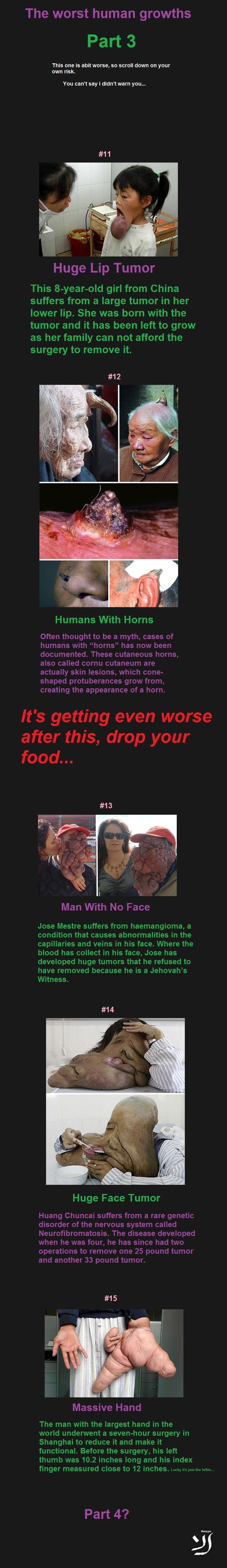 The worst human growths part 3 The worst human growths part 3. Part 1: /funny_pictures/4041152/The+worst+human+growths/ Part 2:/channel/morbid-channel/The+worst+human+growths+part+2/iXoeGvK/